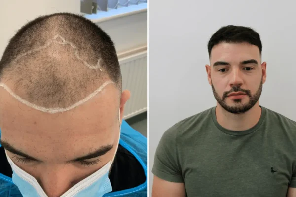 Hair Transplant in UK