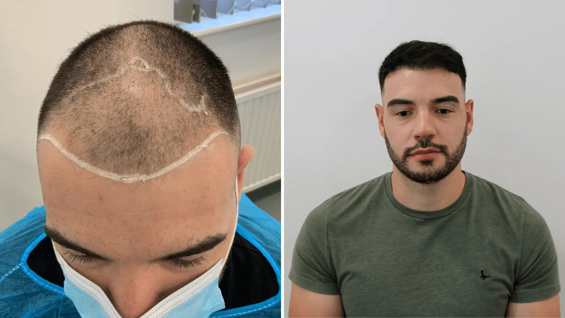 Hair Transplant in UK